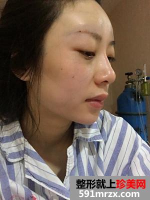 自体脂肪移植垫下巴术恢复过程分享和前后对比照