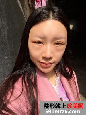 自体脂肪移植垫下巴术恢复过程分享和前后对比照
