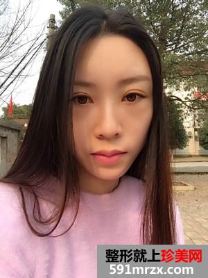 自体脂肪移植垫下巴术恢复过程分享和前后对比照