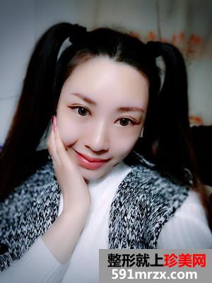 自体脂肪移植垫下巴术恢复过程分享和前后对比照