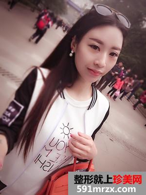 自体脂肪移植垫下巴术恢复过程分享和前后对比照