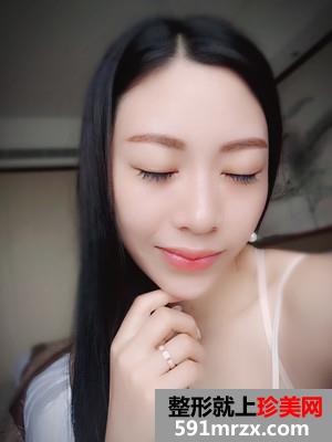 自体脂肪移植垫下巴术恢复过程分享和前后对比照