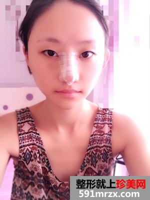 膨体隆鼻术前后照片对比和恢复过程分享