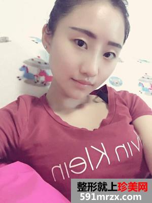 膨体隆鼻术前后照片对比和恢复过程分享
