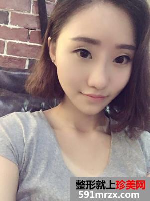 膨体隆鼻术前后照片对比和恢复过程分享