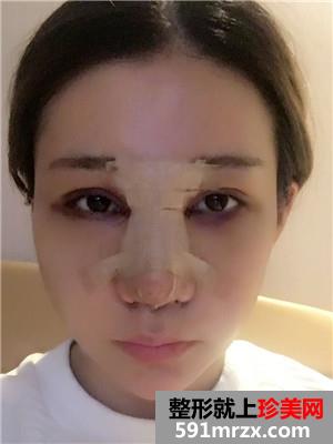 鼻部+眼部综合整形手术前后照对比和案例分享