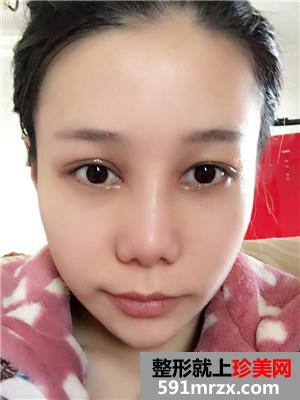 鼻部+眼部综合整形手术前后照对比和案例分享