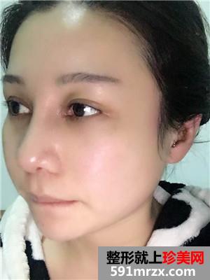鼻部+眼部综合整形手术前后照对比和案例分享