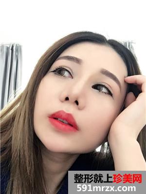 鼻部+眼部综合整形手术前后照对比和案例分享