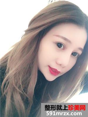 鼻部+眼部综合整形手术前后照对比和案例分享