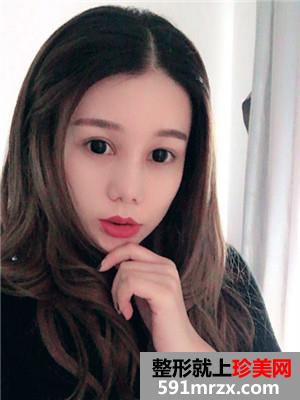 鼻部+眼部综合整形手术前后照对比和案例分享