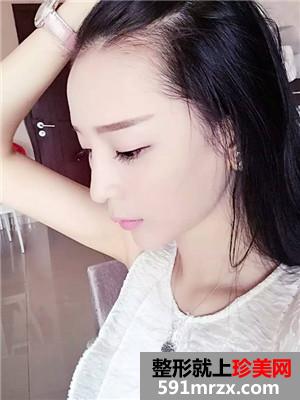 分享自体脂肪填充全脸案例和前后对比照
