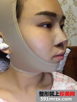 鼻综合修复+双下巴吸脂日记分享和前后对比照