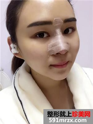 鼻综合修复+双下巴吸脂日记分享和前后对比照