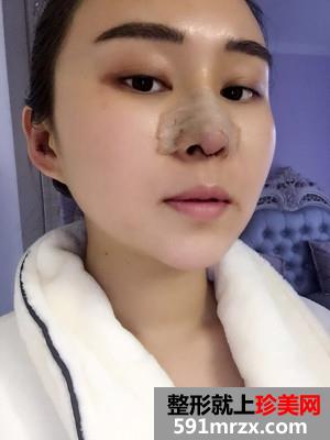 鼻综合修复+双下巴吸脂日记分享和前后对比照