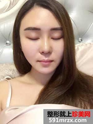 鼻综合修复+双下巴吸脂日记分享和前后对比照