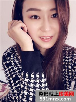 鼻综合修复+双下巴吸脂日记分享和前后对比照