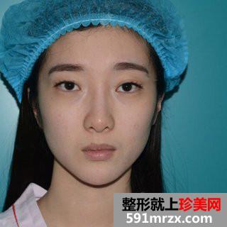 双眼皮修复+自体脂肪填充全脸手术前后对比照和恢复经验分享