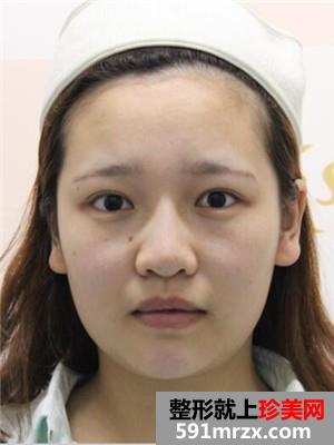 自体脂肪填充额头术真实案例分享和恢复过程对比图