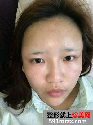 自体脂肪填充额头术真实案例分享和恢复过程对比图
