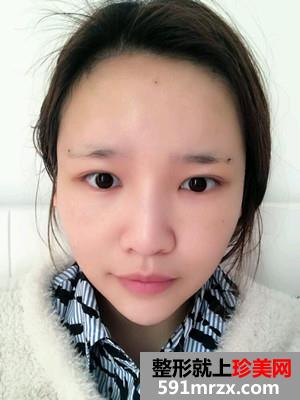 自体脂肪填充额头术真实案例分享和恢复过程对比图