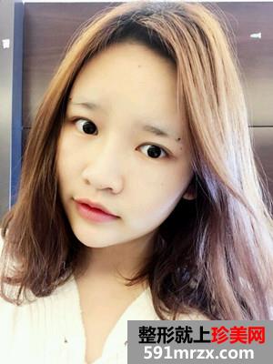 自体脂肪填充额头术真实案例分享和恢复过程对比图