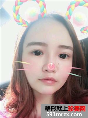 自体脂肪填充额头术真实案例分享和恢复过程对比图
