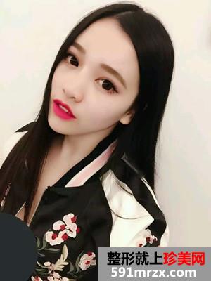 自体脂肪填充额头术真实案例分享和恢复过程对比图