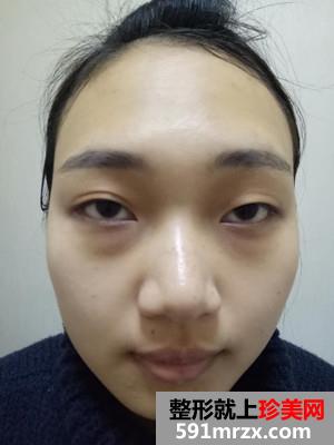 玻尿酸隆鼻+双眼皮修复前后对比照和恢复过程分享