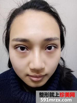 玻尿酸隆鼻+双眼皮修复前后对比照和恢复过程分享