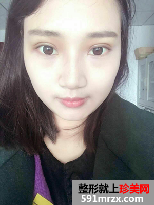 玻尿酸隆鼻+双眼皮修复前后对比照和恢复过程分享
