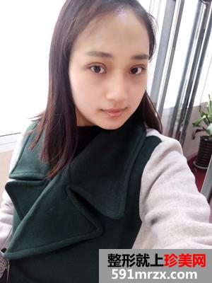玻尿酸隆鼻+双眼皮修复前后对比照和恢复过程分享