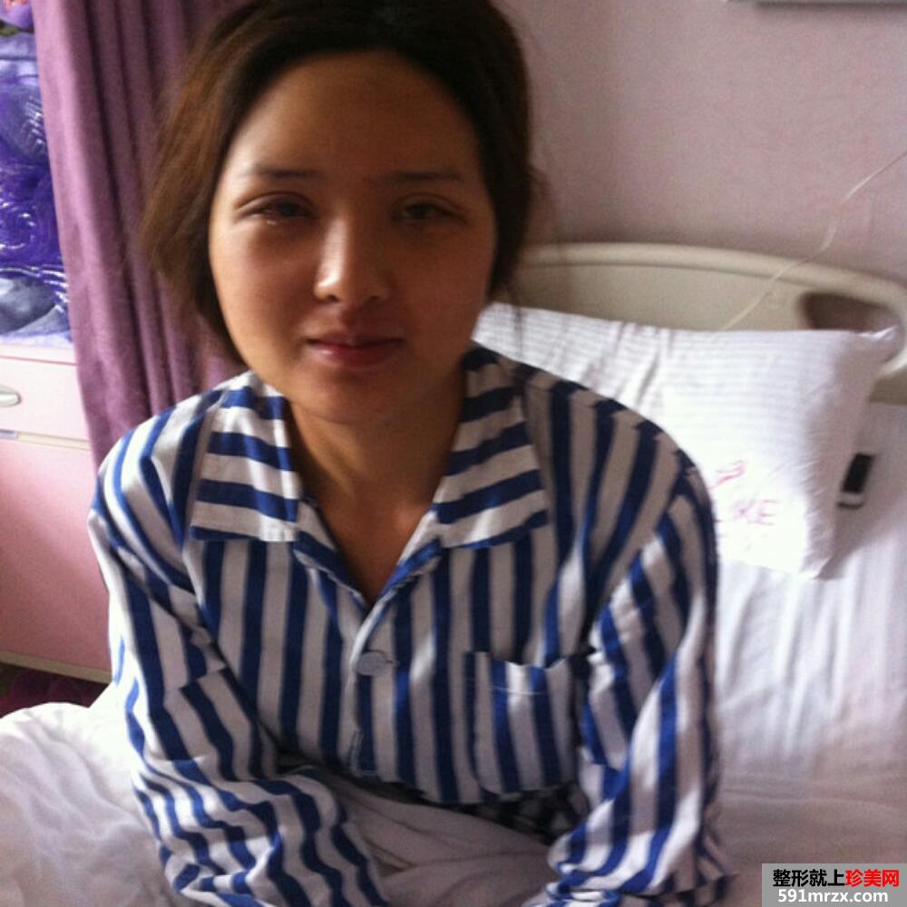 鼻翼缩小+韩式双眼皮手术真实案例分享和前后对比图
