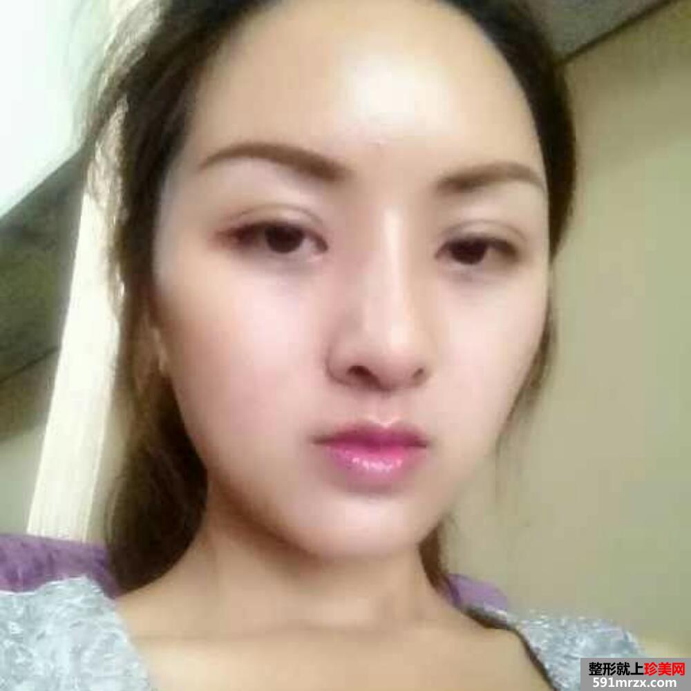 鼻翼缩小+韩式双眼皮手术真实案例分享和前后对比图