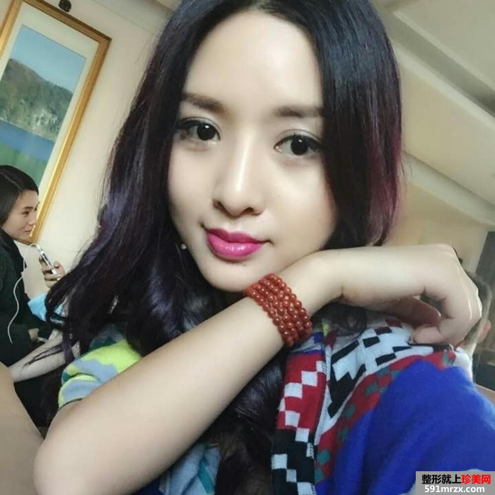 鼻翼缩小+韩式双眼皮手术真实案例分享和前后对比图