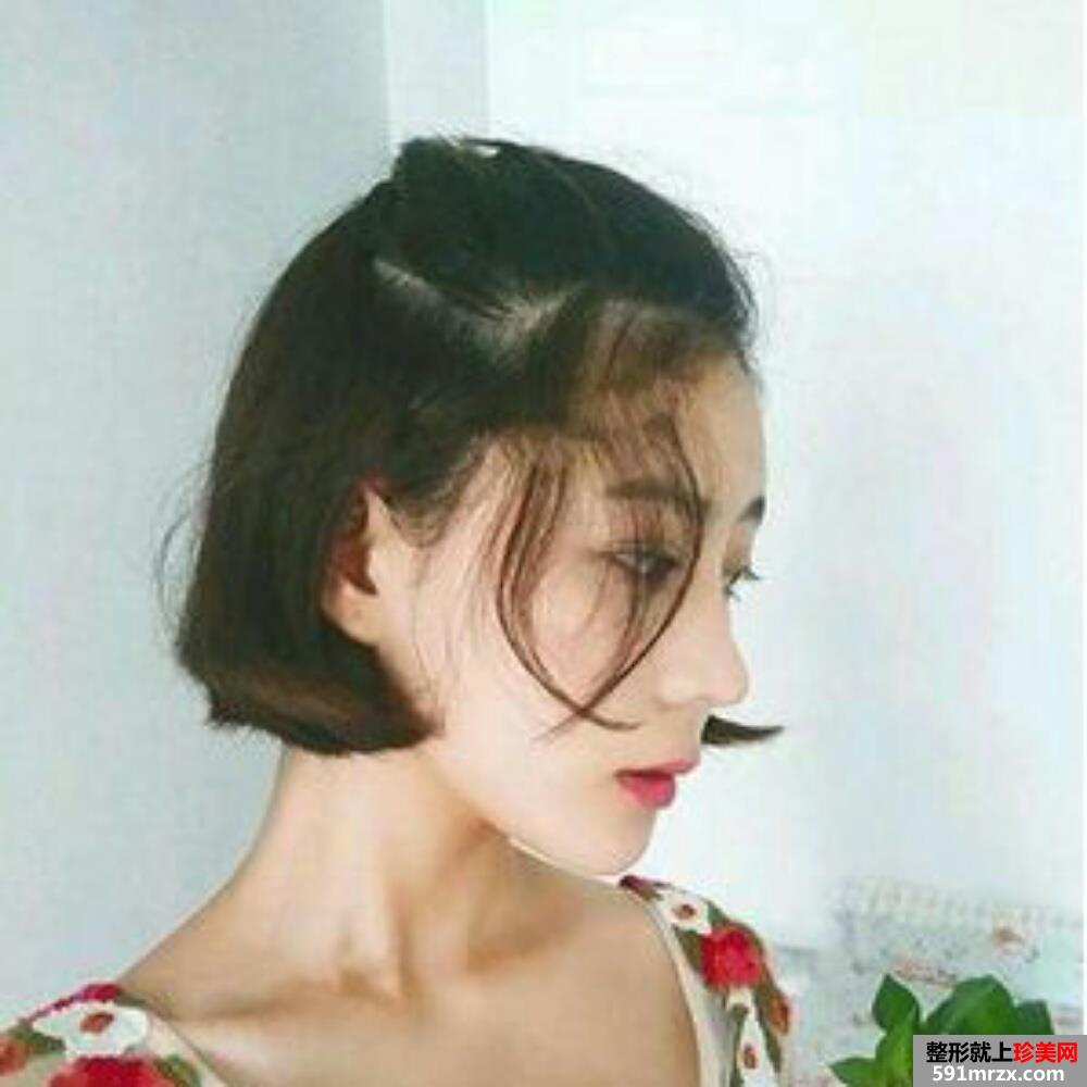 膨体垫下巴手术效果和前后对比照