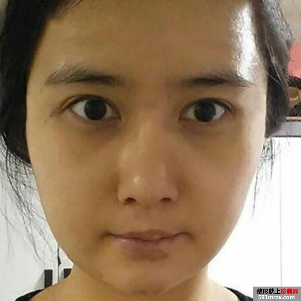 水动力吸脂瘦脸术前后对比照和恢复过程