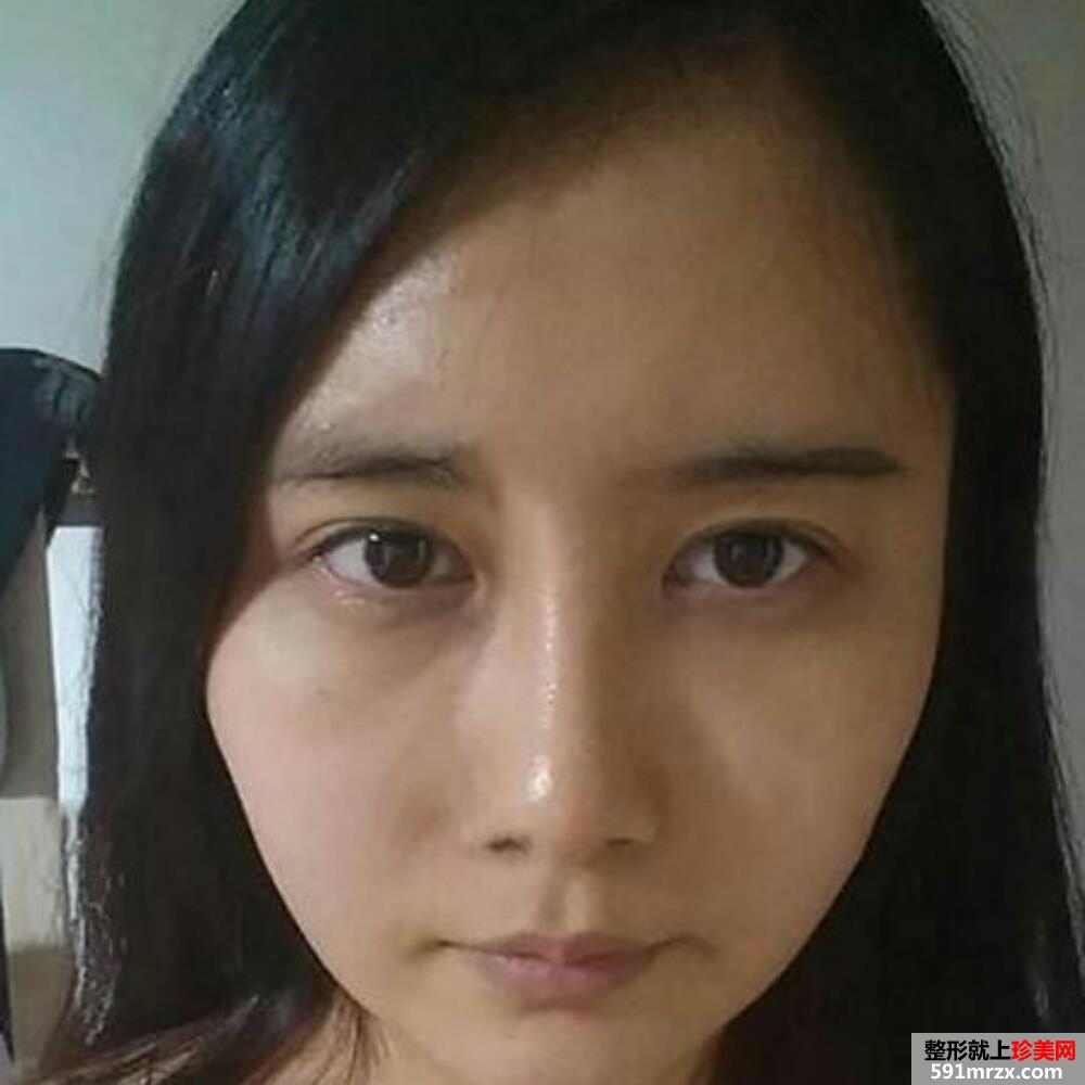 水动力吸脂瘦脸术前后对比照和恢复过程