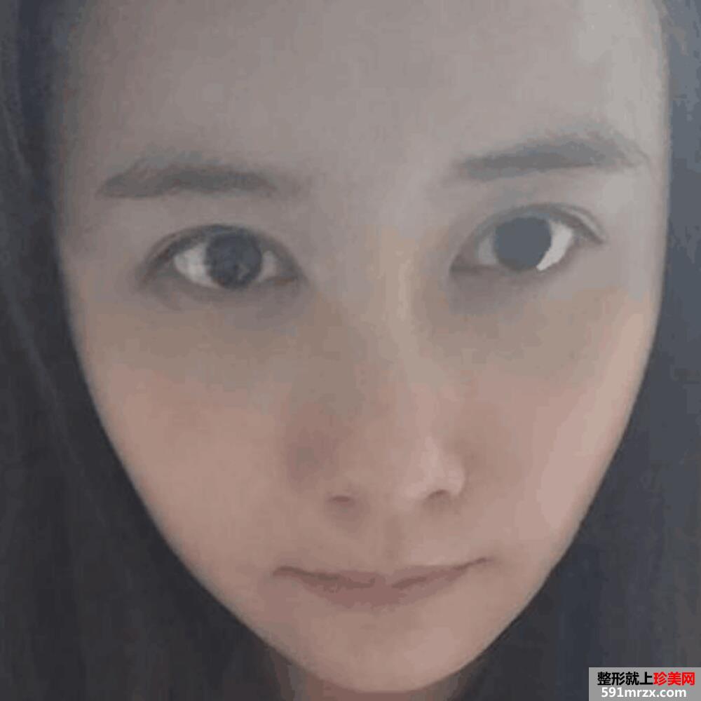 水动力吸脂瘦脸术前后对比照和恢复过程