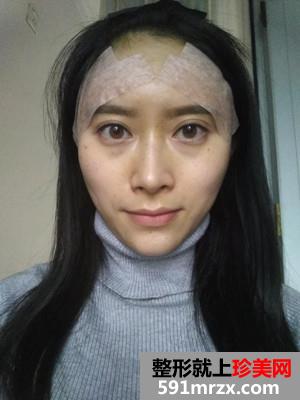 自体脂肪填充额头+太阳穴手术真实案例对比图和恢复过程