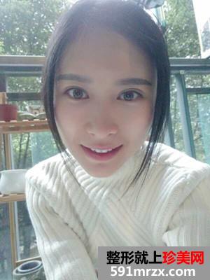 自体脂肪填充额头+太阳穴手术真实案例对比图和恢复过程