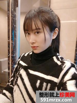 自体脂肪填充额头+太阳穴手术真实案例对比图和恢复过程