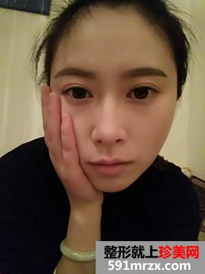 自体脂肪填充额头+太阳穴手术真实案例对比图和恢复过程