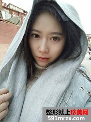 自体脂肪填充额头+太阳穴手术真实案例对比图和恢复过程