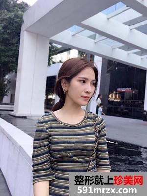 保妥适瘦脸除咬肌日记分享还有前后恢复照片对比哦