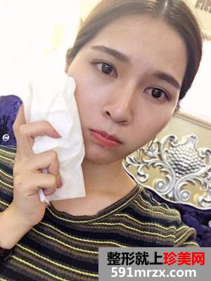 保妥适瘦脸除咬肌日记分享还有前后恢复照片对比哦