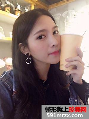 保妥适瘦脸除咬肌日记分享还有前后恢复照片对比哦