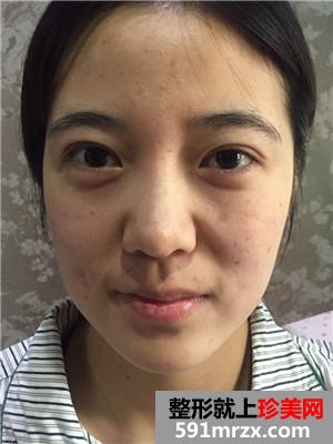 面部吸脂和自体脂肪填充效果对比还有恢复的详细过程