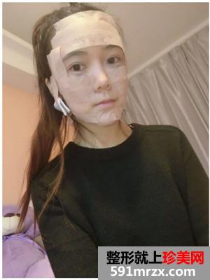 面部吸脂和自体脂肪填充效果对比还有恢复的详细过程