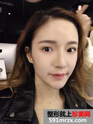 自体脂肪丰额头和太阳穴效果对比照和恢复过程
